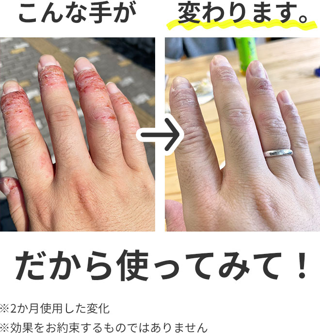 こんな手が → 変わります
※2か月使用した変化
※効果をお約束するものではありません
